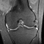 Увреждане на менискуса на колянната става: симптоми (признаци и снимки), лечение, причини