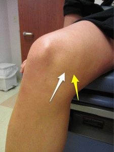 Увреждане на колянната менискуса