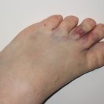 Деструкция на пръста на крака (голям и малък пръст): симптоми и лечение
