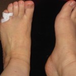 Деструкция на пръста на крака (голям и малък пръст): симптоми и лечение