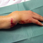 Дислокация на ръката: симптоми и лечение на китката
