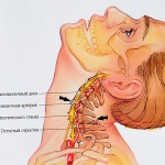 Дислокация на шията: симптоми и лечение на навяхване (снимка)