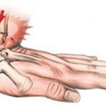 Изместване на китката: симптоми и лечение на ръчно разтягане