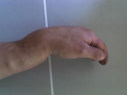 Изместване на костите с фрактура на ръката: симптоми и действия с травма