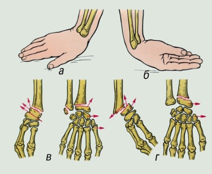 Изместване на костите с фрактура на ръката: симптоми и действия с травма