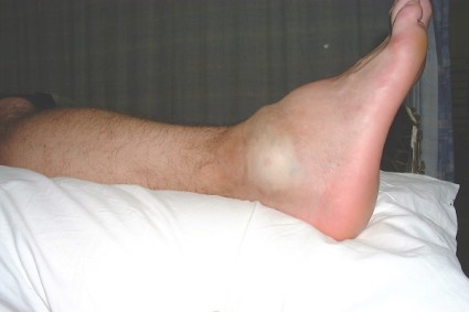 Ефективни процедури за нараняване на крака