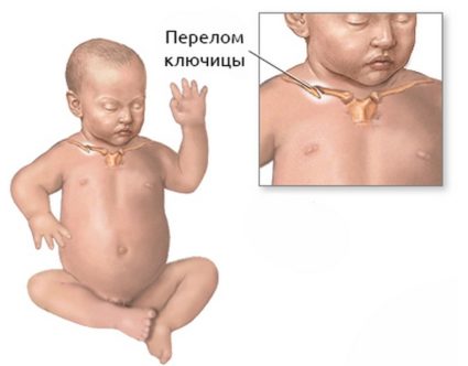 Характеристики на фрактура на ключицата при новородени