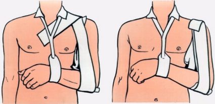 Характеристики на оздравяването след изместване на рамото