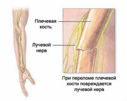 Фрактура на раменната кост с изместване: лечение и рехабилитация при възрастни и деца