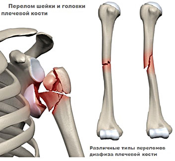 Фрактура на раменната кост с изместване: лечение и рехабилитация при възрастни и деца
