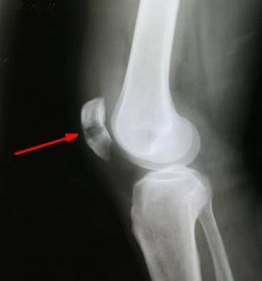Фрактура на коляното - причини и последици от травмата