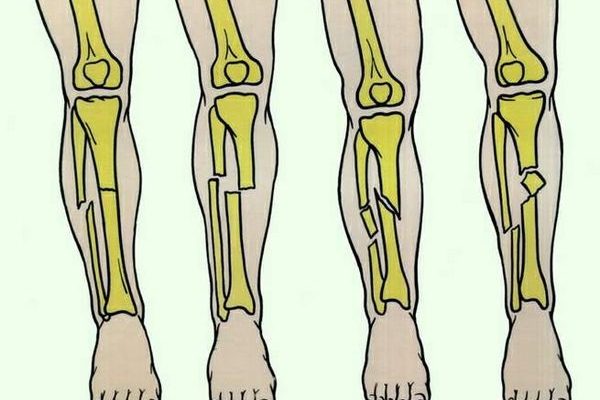 Фрактура на краката: симптоми и лечение