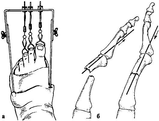 Фрактура на скуоидната кост на крака