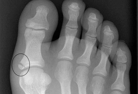 Счупване на палеца и малък пръст на крака