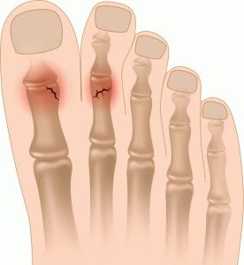 Как да разпознаете счупен пръст на крака