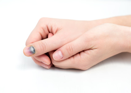 Как да осигурите първа помощ в случай на нараняване на пръстите в дома