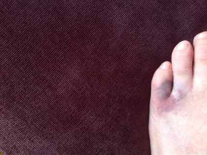 Как да се справим със счупен пръст на крака - малък пръст