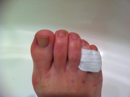 Как да се справим със счупен пръст на крака - малък пръст