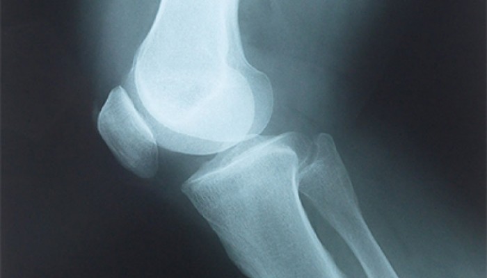 Как да се лекува нараняване на коляното у дома?