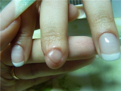 Как да се лекува натъртено ноктите на ръката?