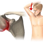 Как да се лекува изкълчване на рамото: симптоми (знаци върху снимката), първа помощ у дома
