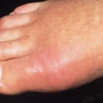 Възпаление на ставата на големия пръст: лечение, симптоми, снимка