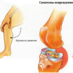 Фрактура на менискуса: симптоми на разкъсване и притискане на колянната става