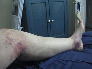 Мази от нараняване на крака