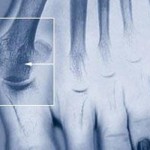 Болка в костта на големия пръст: причини и лечение