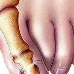 Болка в костта на големия пръст: причини и лечение