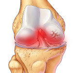 Болка в ставите на краката: причините и лечението на заболявания на краката и коляното