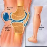 Болка в коленете: защо са болките, причините и лечението?
