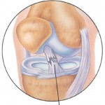 Рязко разкъсване на предния кръстосан сухожилие на колянната става: частично увреждане на ПКК