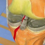 Рязко разкъсване на предния кръстосан сухожилие на колянната става: частично увреждане на ПКК