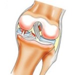 Разрушаване на рога на медиалния менискус на колянната става: лечение и симптоми