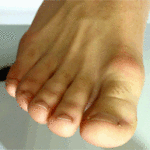 Растеж на палеца: лечение на конуси