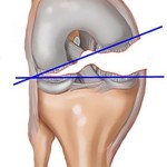 Тежка болка в коляното: какво да направите, ако коляното е много възпалено