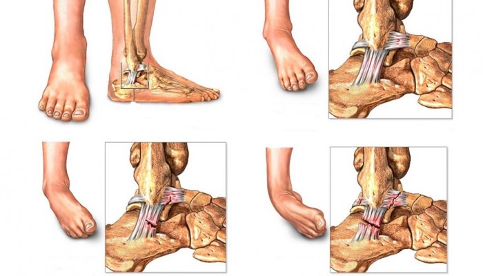 Разтягане на краката на краката: лечение в дома