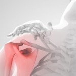 Протягане на мускулите и сухожилията на раменната става: симптоми, признаци и лечение на разкъсвания на рамото