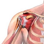 Протягане на мускулите и сухожилията на раменната става: симптоми, признаци и лечение на разкъсвания на рамото