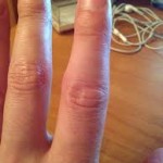 Подуване на ставата на пръста: какво да се направи и как да се премахне подуването