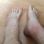Подути стави по краката: лечение на глезените, петите, коленете и коленете