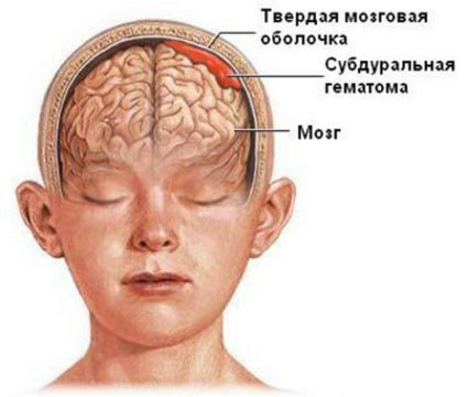 Симптоми и лечение на контузии на мозъка