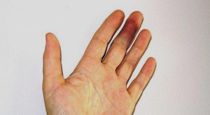 Симптоми и лечение на наранен пръст върху ръката или крака