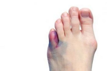 Симптоми и лечение на наранен пръст върху ръката или крака