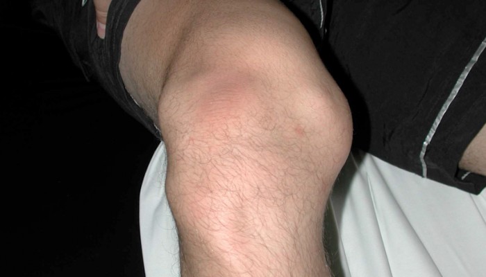 Симптоми и лечение на изкълчване на коляното