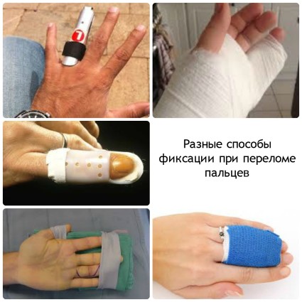 Симптоми, диагноза, лечение и рехабилитация на фрактури на пръстите