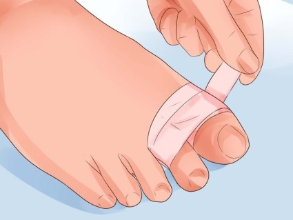 Симптомите на фрактура на големия пръст и методи на лечение