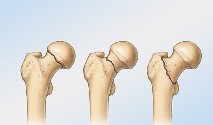 Симптоми, лечение и последици от фрактурата на бедрената кост при пациенти в старческа възраст