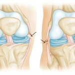 Разкъсване на коленния лигамент: симптоми и лечение на кръстосаните връзки на коляното